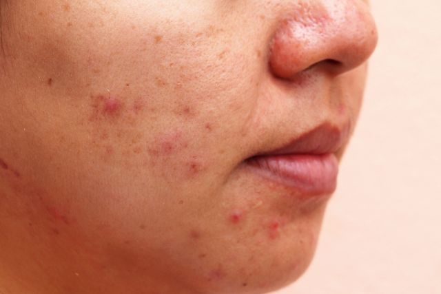 Acne spots: what are they?